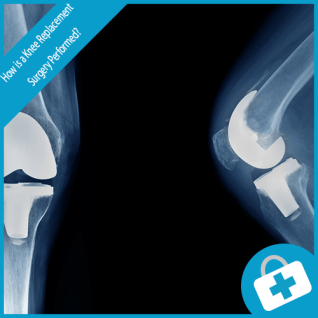 How is a Knee Replacement Surgery Performed?